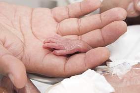 A preterm infant hand.