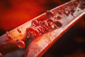 medical illustration of arterial plaque