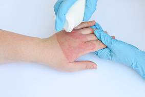 A doctor's hands treating a hand with second degree burns.