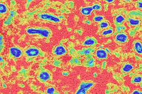 Tissue samples showing substantial stromal disruption in the breast. 