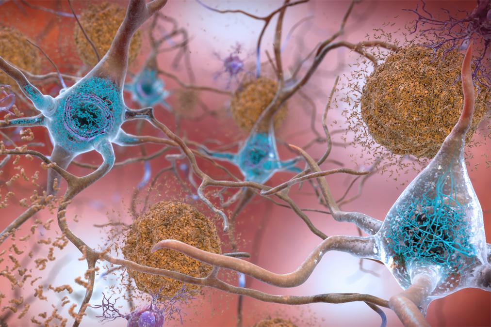 Illustration of amyloid plaques and tau tangles, colored in brown, surrounded by brain cells, colored in cyan and purple
