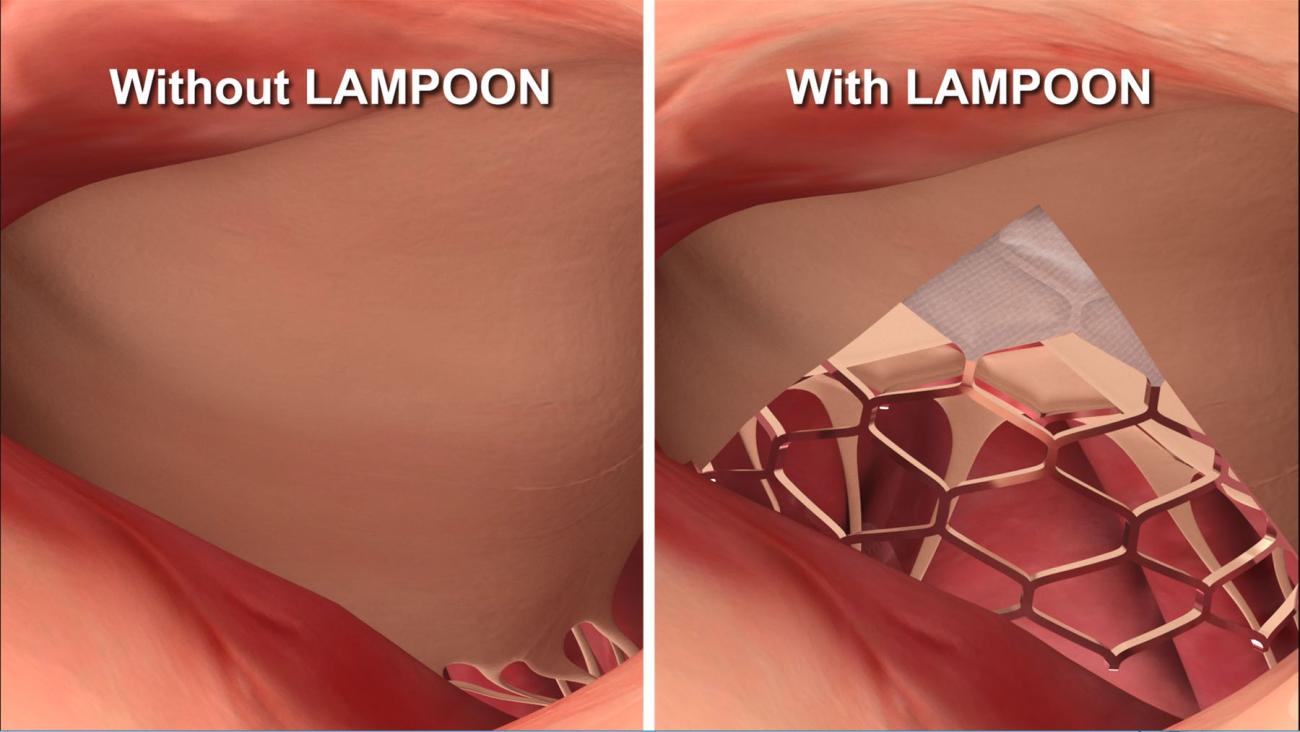 20190520-lampoon.jpg Illustration showing a transcatheter mitral valve implantation with and without LAMPOON.
