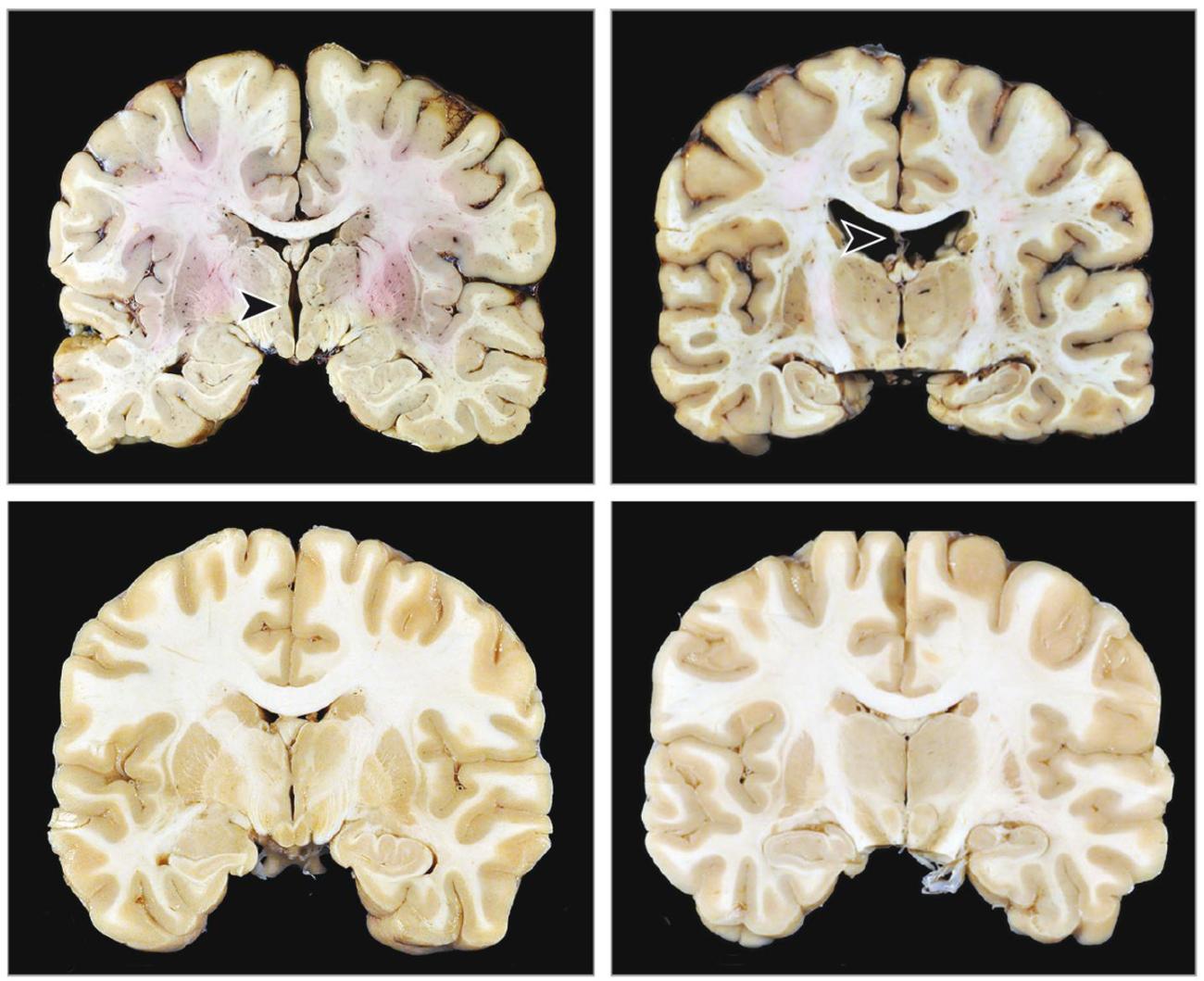 Chronic traumatic encephalopathy visual data 7