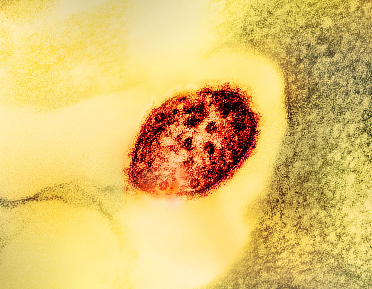 Imagem de uma micrografia eletrônica de transmissão colorida de uma partícula do vírus do sarampo (vermelho).