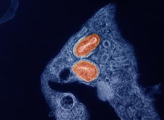 Tecovirimatは安全であるが、クレードII型mpoxの治療としては無効である(Tecovirimat is safe but ineffective as treatment for clade II mpox)