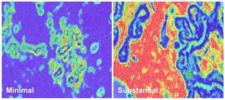 乳がんリスクを示す新たな組織バイオマーカーを発見(NIH Researchers Discover Tissue Biomarker That May Indicate Higher Risk of Aggressive Breast Cancer Development and Death) 乳がんリスクを示す新たな組織バイオマーカーを発見(NIH Researchers Discover Tissue Biomarker That May Indicate Higher Risk of Aggressive Breast Cancer Development and Death)