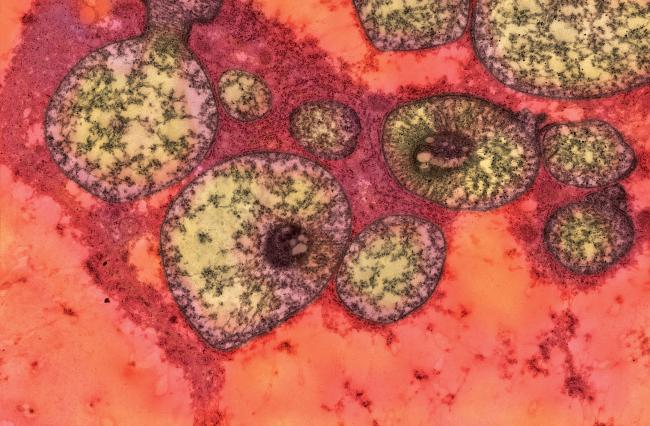 Electron micrograph of abnormally shaped mitochondria.