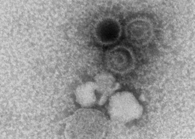 20180424-ebv-micrograph.jpg Epstein-Barr virions