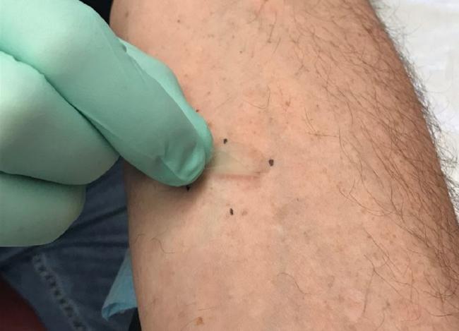 20190202-niaid-collecting-skin-samples.jpg A gloved hand of a researcher peels a small, clear tape strip up from a bare arm.