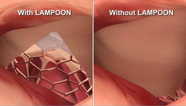 Illustration of heart valve leaflets with and without LAMPOON