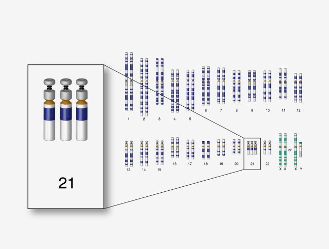 Trisomy