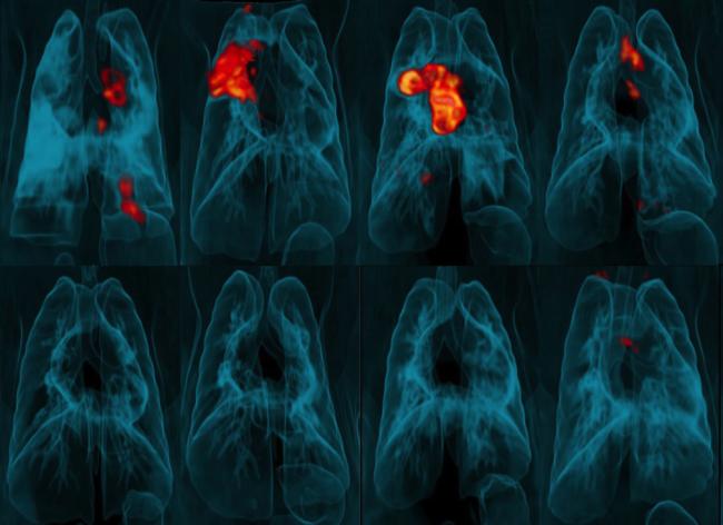 Image of PET-CT lung scans