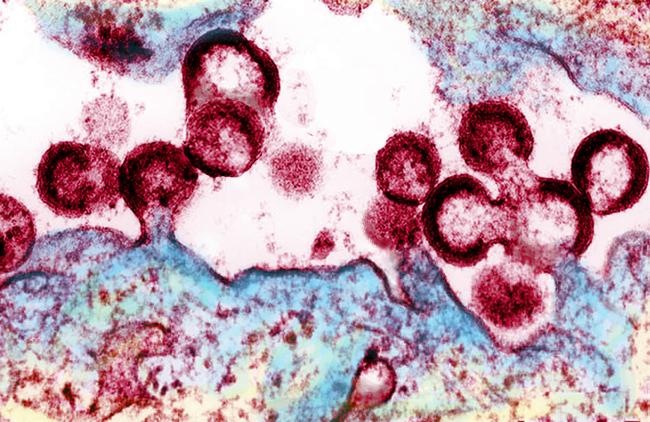 Image of HIV virions budding from an infected cell
