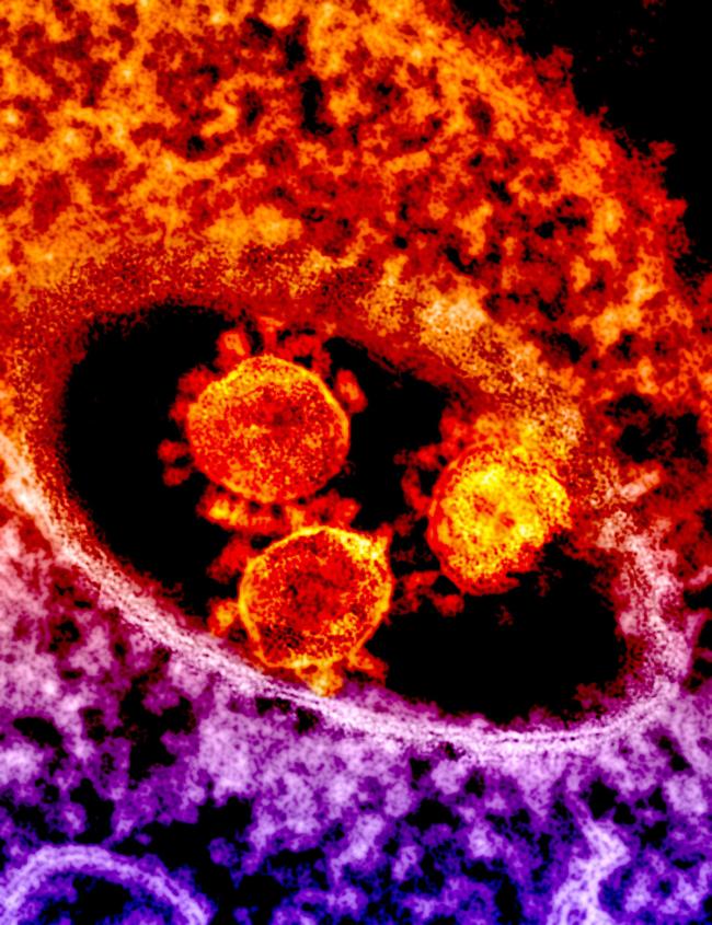 Electron micrograph showing particles of the MERS Coronavirus