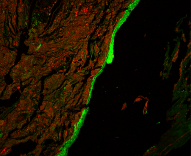 20201103-human.png Immunofluorescent image of mucus barrier around red mass