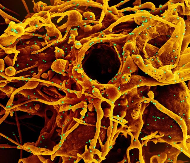 Colorized scanning electron micrograph of a cell (orange) infected with UK B.1.1.7 variant SARS-CoV-2 virus particles (green), isolated from a patient sample.