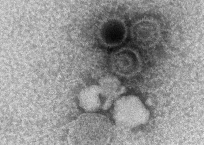 Photo taken with microscope of Epstein-Barr virions in black and white