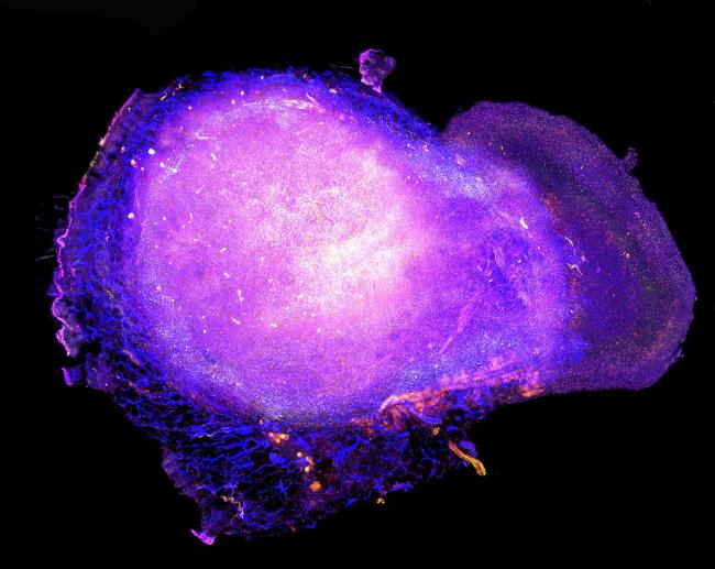 20240624-cancerAI Transparent tumor tomograph image of numerous immune cells around a larger tumor.