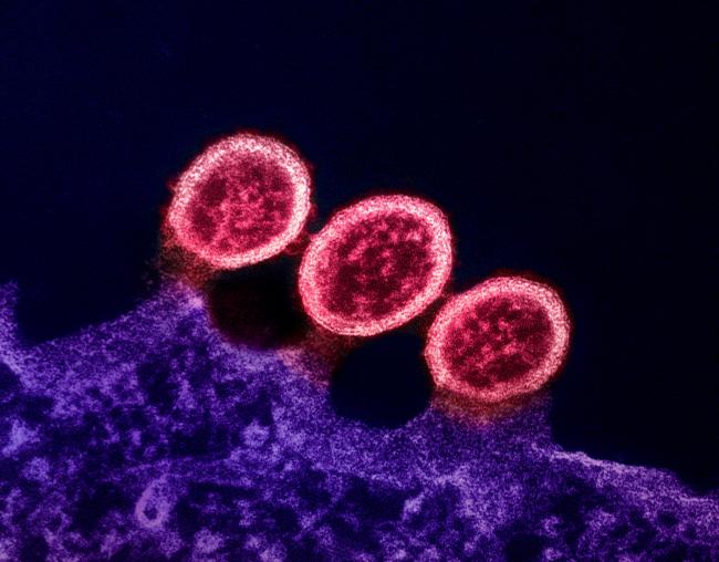 Transmission electron micrograph of HIV-1 virus particles