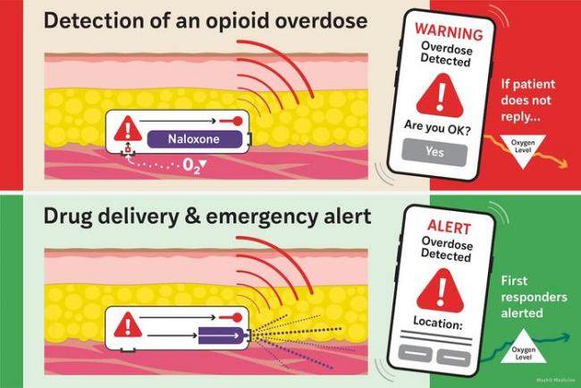 Schematic illustration of the implantable Naloximeter device shows that detection of an opioid overdose leads to a warning on a mobile device. If the patient doesn’t reply, the drug is delivered and first responders are alerted.