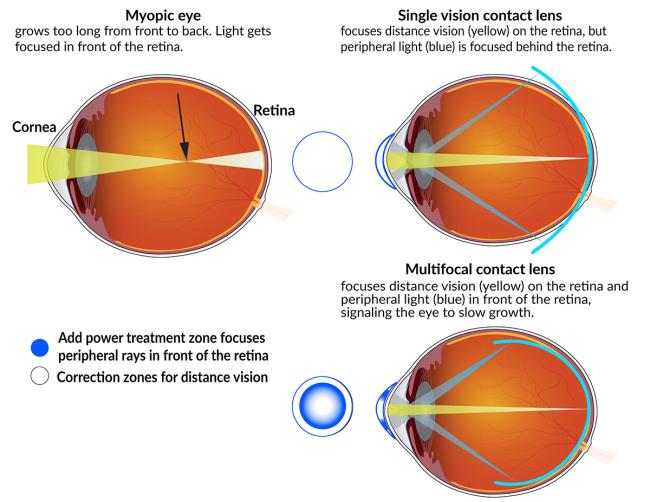 Myopic eyes grow too long from front to back, so light gets focused in front of the retina. Single-vision contact lenses focus distance vision on the retina, but peripheral light behind it. Multifocal lenses focus peripheral light in front, slowing growth