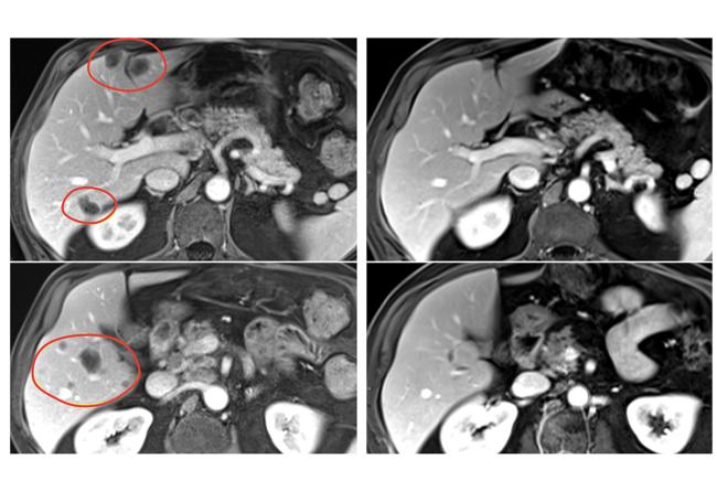 Image of an MRI scan showing shrinkage of multiple liver metastases from a patient with rectal cancer.