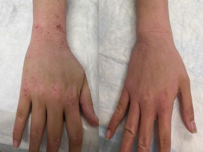 Two photos of the same hand. On the left, the skin has a red rash. On the right, the skin does not.