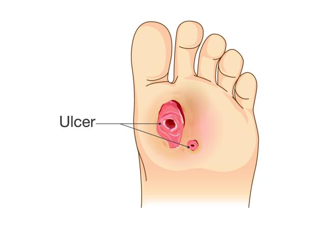 Scientists identify diagnostic aid to determine risk of diabetic