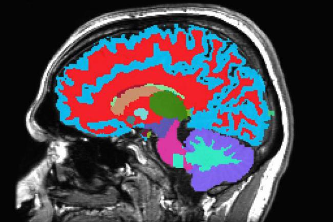 MRI brain scan image.