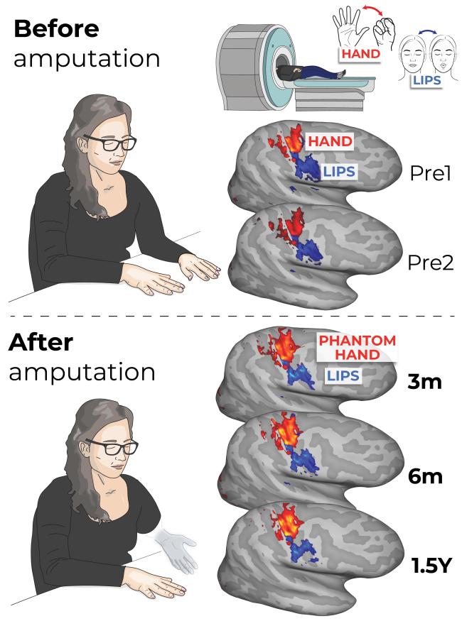 Illustration of a study participant scanned before and after amputation.