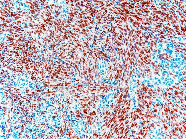 Expression of HHV-8 LANA in Pediatric Kaposi Sarcoma
