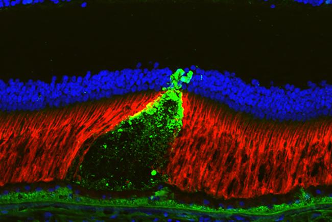 Researchers find genetic basis for important risk factor in blinding eye disease. Image of a reticular pseudodrusen appears as a cone-shaped structure with its base at the retinal pigment epithelium, and it disrupts the outer retina (red). Dr. Erica Fletcher, University of Melbourne