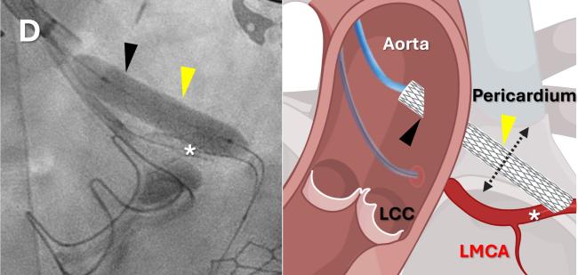 Image shows side-by-side a fluoroscopy image and an artists rendering of the stent graft being deployed to create a new path for blood to flow from the aorta to the left main coronary artery.