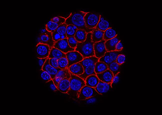 Pancreatic cancer cells.