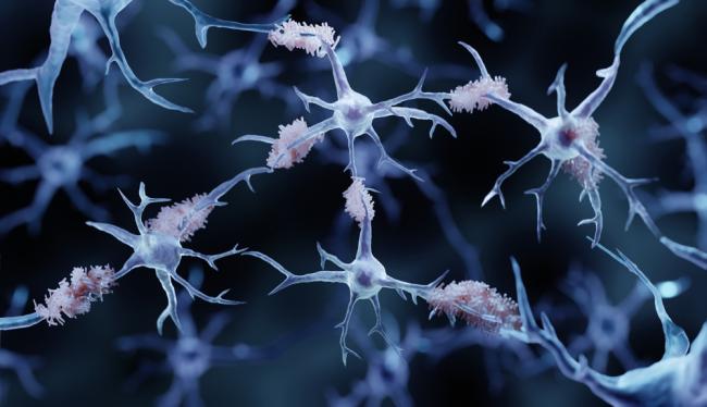 3-D illustration of amyloid plaques and neurons.