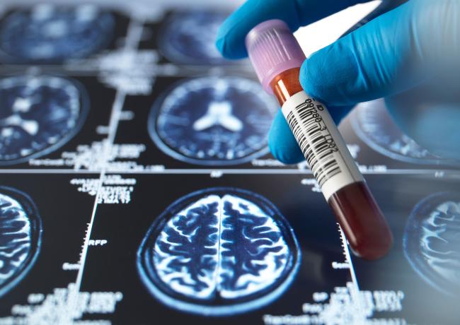 New Alzheimer’s blood test may tell when symptoms are around the corner