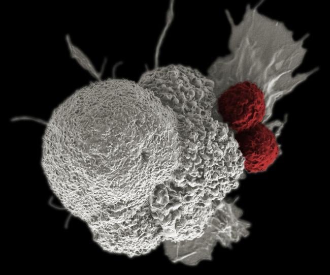  3d illustration of a pseudo-colored scanning electron micrograph of an oral squamous cancer cell (white) being attacked by two cytotoxic T cells (red). 