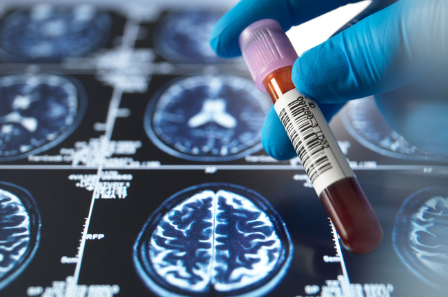 Close-up shot of a medical professional holding a blood sample vial over brain scan images