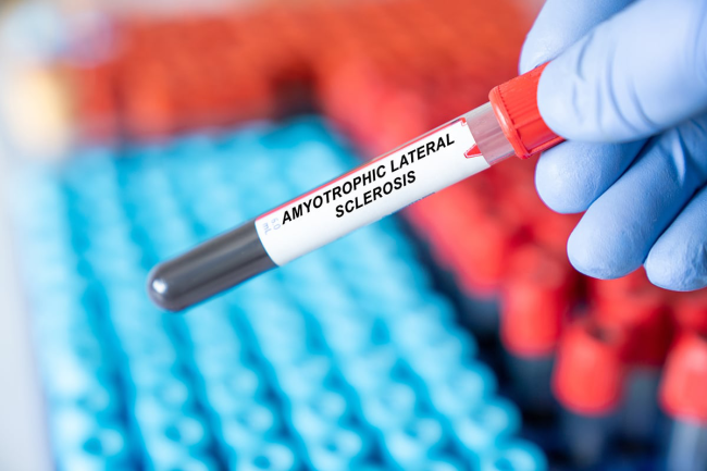 Gloved hand holding a blood-filled tube labeled Amyotrophic Lateral Sclerosis