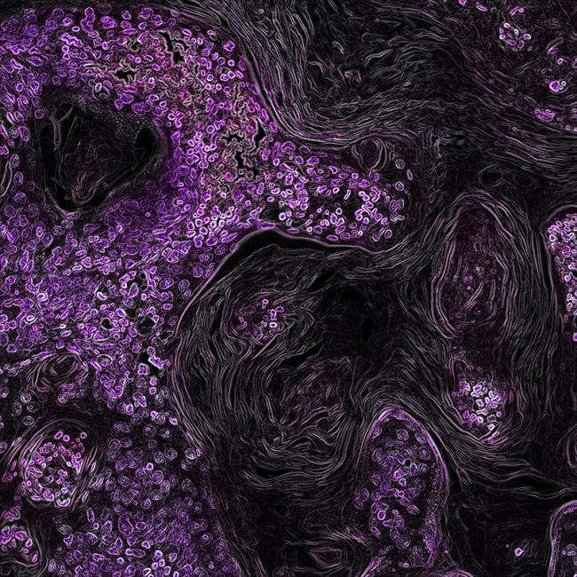 Microscope image of a tumor in a mouse lung. 