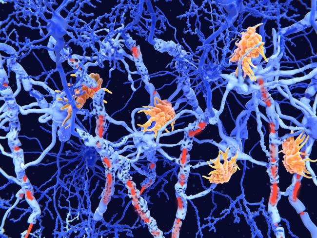 Illustration of microglia cells attacking and destroying parts of the myelin sheath.