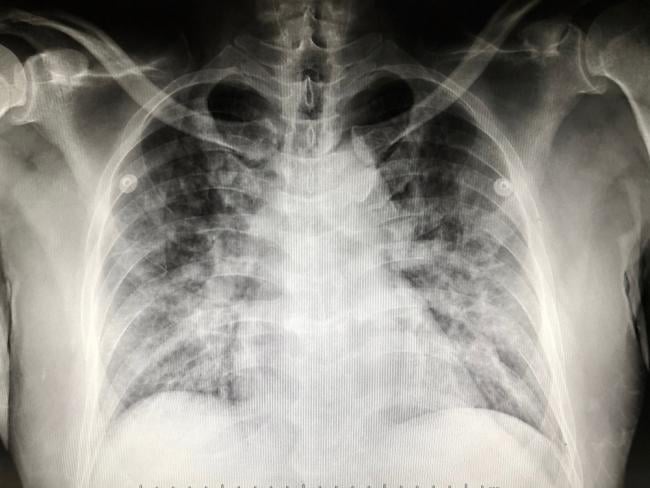 X-ray of the human lung. 