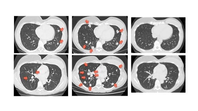Alt text: A series of chest CT scans  