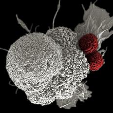 Shown here is a pseudo-colored scanning electron micrograph of an oral squamous cancer cell (white) being attacked by two cytotoxic T cells (red), part of a natural immune response. Nanomedicine researchers are creating personalized cancer vaccines by loading neoantigens identified from the patient's tumor into nanoparticles. When presented with immune stimulants, this activates the patient's own immune system, leading to expansion of tumor-specific cytotoxic T cells.
URL: https://visualsonline.cancer.gov/details.cfm?imageid=10486
