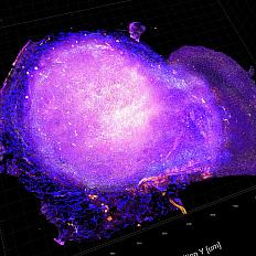 Using a novel imaging technique called transparent tumor tomography that three-dimensionally visualizes the tumor microenvironment at a single cell resolution, researchers obtained this image from a mouse model for HER2-positive breast cancer. Shown are cytotoxic T cells (CD3 in yellow; CD8 in red; , CD31 in blue) attacking the tumor after treatment with radiation and a PD-L1 immune checkpoint blockade therapy. New knowledge about the mechanism of inducing anti-tumor immune responses may lead to better treatments.
URL: https://visualsonline.cancer.gov/details.cfm?imageid=10588
