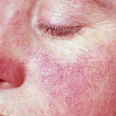  A woman with a characteristic lupus skin rash — the so-called butterfly rash — across her nose and cheeks.