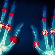 A horizontal X-ray image depicting joint damage from rheumatoid arthritis.