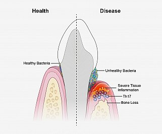 A new study suggests that periodontal disease is driven by Th17 immune cells, which are triggered by an unhealthy bacterial community. 