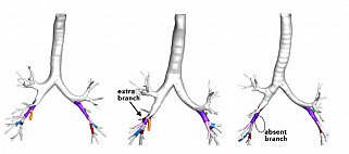 The lung airways of 1 in 4 people don’t follow the standard branching pattern (left). People who possess common variations (middle and right) may have a greater risk of COPD. 