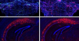 Obstructing lymphatic vessels (green) in a mouse model of Alzheimer’s disease significantly increased buildup of harmful amyloid-beta (red) in the brain. Left panels, control mouse; right, after disruption of lymphatic vessels. Top panels, meninges; bottom, hippocampus region.